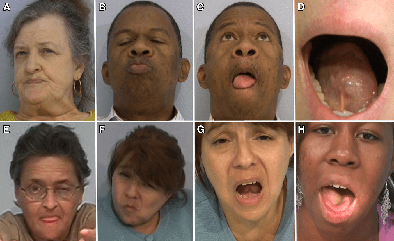 Discinesia tardia e a penitência de psicóticos e anfetamina DIMPNA