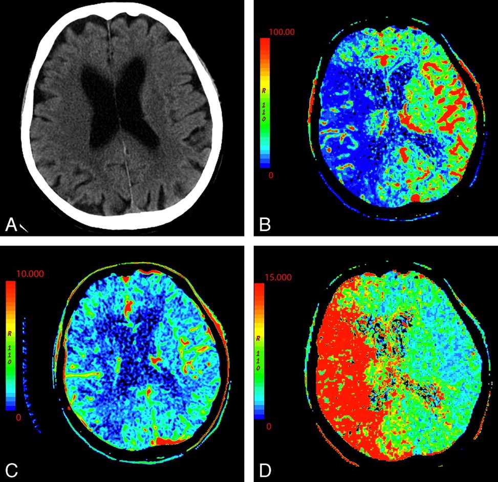 CT perfusion imaging takes over the scene in acute stroke • Dimpna